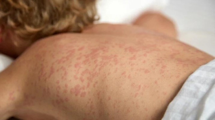  Reportan primera defunción por Sarampión en Sinaloa